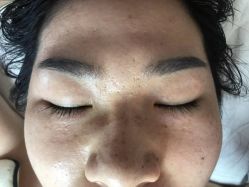 -美丽人生祛斑扁平疣汗管瘤中心