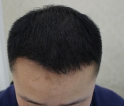 -大麦微针植发全国连锁