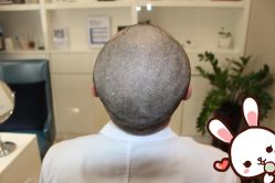 -大麦微针植发丨全国连锁