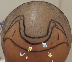 -大麦微针植发全国连锁