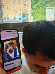 -碧莲盛·不剃发植发