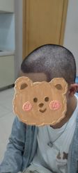 -大麦微针植发丨全国连锁