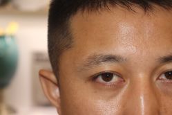 -大麦微针植发丨全国连锁