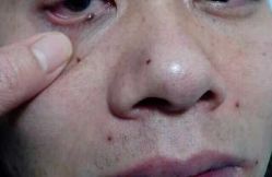 -北京美痣堂古方祛痣斑疣瘊