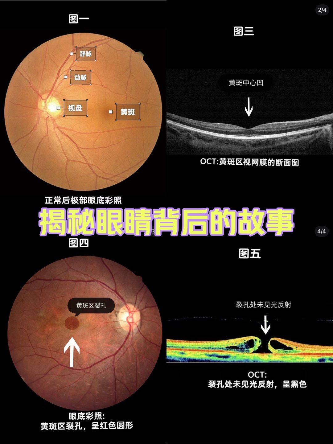 常见眼底报告解读
