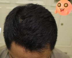 -大麦微针植发丨全国连锁