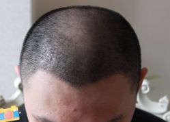 -大麦微针植发丨全国连锁
