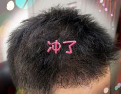 -大麦微针植发全国连锁