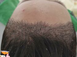 -大麦微针植发丨全国连锁