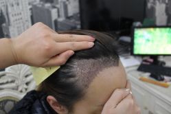 -大麦微针植发丨全国连锁