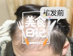 -大麦微针植发全国连锁