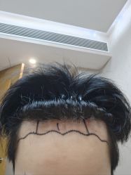 -大麦微针植发全国连锁