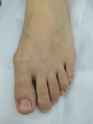 -德哥灰指甲脚气甲沟炎跖疣护理