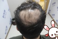 -大麦微针植发丨全国连锁