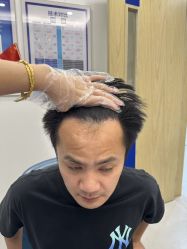 -大麦微针植发全国连锁