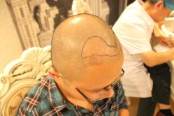 点击看大图 -大麦微针植发丨全国连锁