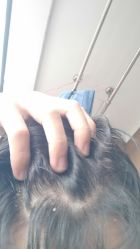 点击看大图 -碧莲盛·不剃发植发