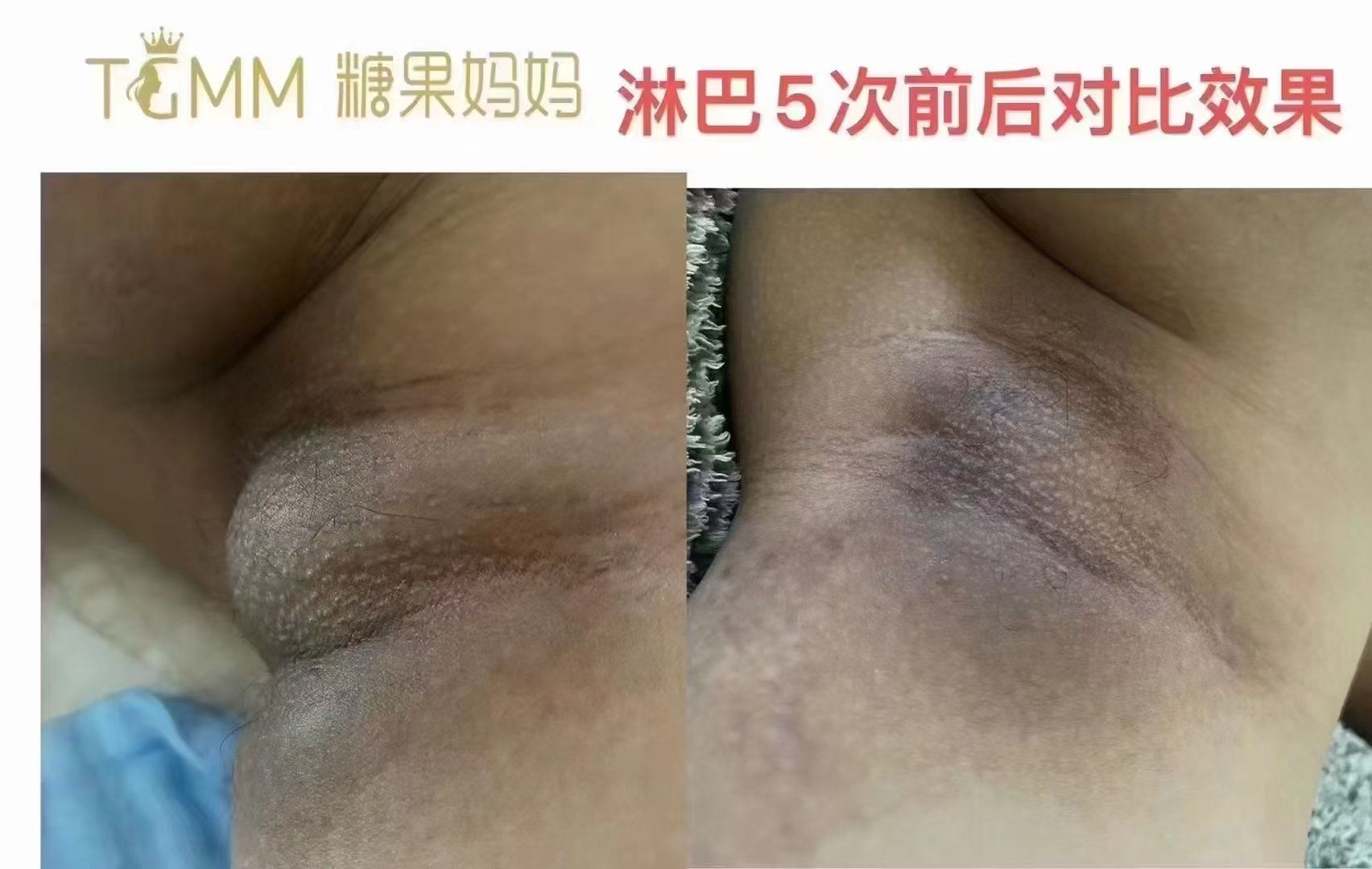 淋巴於堵,导致副乳形成