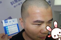 -大麦微针植发丨全国连锁