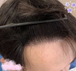 -大麦微针植发丨全国连锁