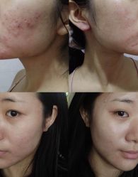 -蕾特恩专业祛痘国际连锁