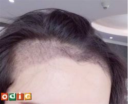-大麦微针植发全国连锁