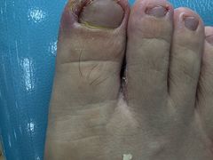 -世龙世家甲沟炎·灰指甲·嵌甲矫正·修脚(武侯区双楠店)