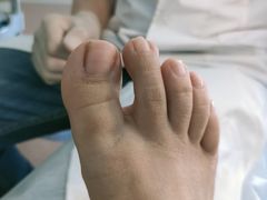 -世龙世家灰指甲鸡眼脚气甲沟炎跖疣护理(通州店)