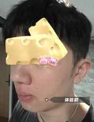 体验前-深圳美莱医疗美容医院