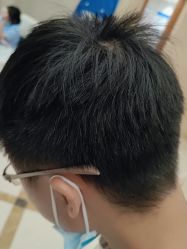 点击看大图 -碧莲盛·不剃发植发