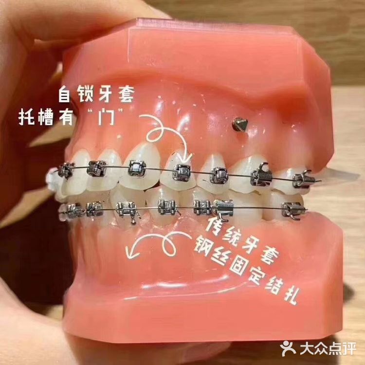 隐形牙套、钢托槽、陶瓷托槽的区别  