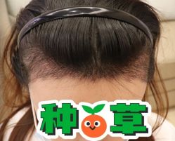 -大麦微针植发丨全国连锁