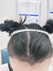 -大麦微针植发丨全国连锁