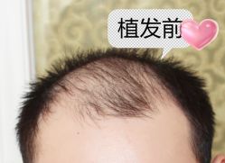 -大麦微针植发丨全国连锁