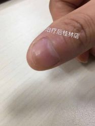 点击看大图 -德哥灰指甲脚气甲沟炎跖疣护理