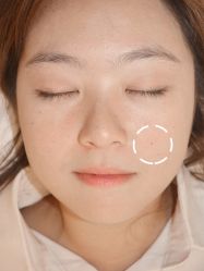 -清疣美疣·痣·斑净肤中心