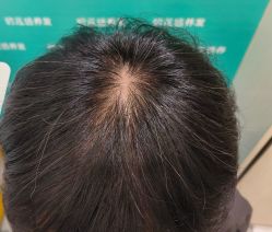 -碧莲盛·不剃发植发