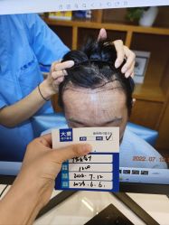 -大麦微针植发全国连锁