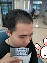 -大麦微针植发丨全国连锁