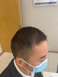 -大麦微针植发丨全国连锁