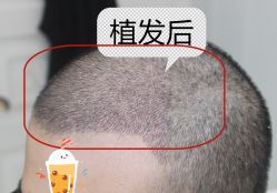 -大麦微针植发全国连锁