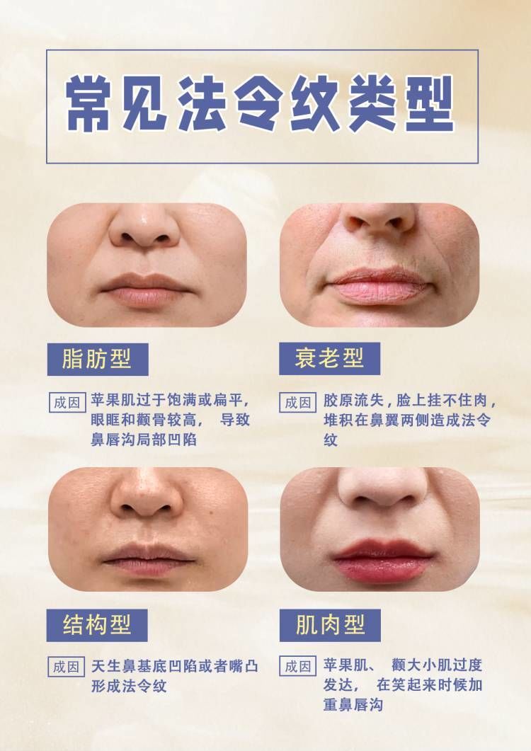 30秒自测法令纹