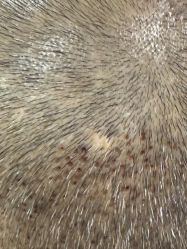 -碧莲盛·不剃发植发