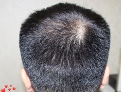 -大麦微针植发丨全国连锁
