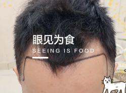 -大麦微针植发全国连锁