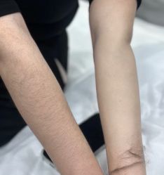 -薇兰专业脱毛连锁机构