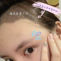 -碧莲盛·不剃发植发
