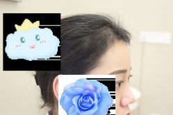 -大麦微针植发丨全国连锁