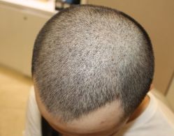 -大麦微针植发全国连锁