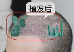 -大麦微针植发全国连锁